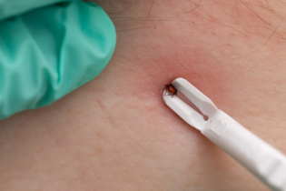 Bild für اگر کنه ما را گزید چه کنیم و چگونه میتوان آن را از بدن جدا کرد؟